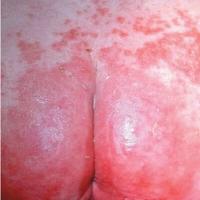 
	Candida

	Satellite lesions present, skin folds…