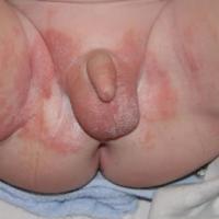 
	Napkin eczema - a contact irritant…