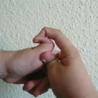 
	Ehlers&ndash;Danlos syndrome

	&nbsp;