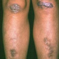 
	Ehlers&ndash;Danlos syndrome

	Copied with kind…