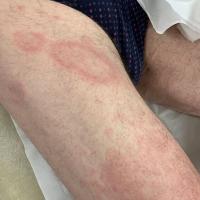 Eosinophilic annular erythema
This patient had…