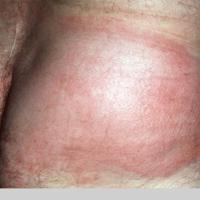 
	Eosinophilic cellulitis
