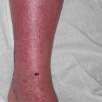 
	Eosinophilic cellulitis