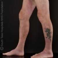 Eosinophilic fasciitis
Copied with kind…