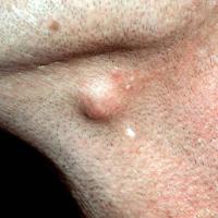 
	Epidermoid cyst

	Lesions found close to the…