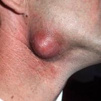 
	Epidermoid cyst - infected&nbsp;