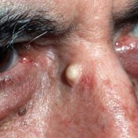 
	Epidermoid cyst