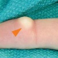 
	An inclusion epidermoid cyst caused by…