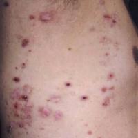 Generalised inflammatory EBA