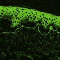 
	EBA

	Immunofluorescence on salt-split skin…