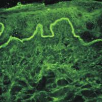 
	EBA

	Direct immunofluorescence on perilesional…
