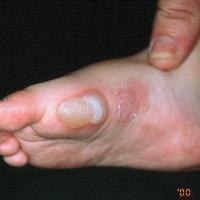 
	EB - a&nbsp;mechanically induced blister

	This…