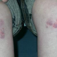 
	Erythema elevatum diutinum