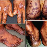 
	Erythema elevatum diutinum
Copied with kind…