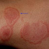 
	EM 

	Three rings (black arrow) and two rings…