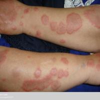 
	EM - atypical lesions