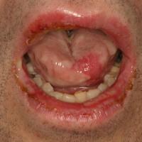 
	EM with mucosal involvement&nbsp;

	Copied with…