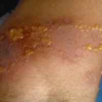 
	Linear IgA disease, not EM