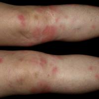 
	Erythema nodosum

	Copied with kind permission…
