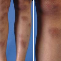 
	Erythema nodosum