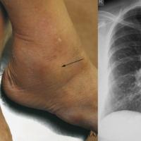 
	Erythema nodosum caused by sarcoidosis