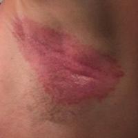 
	Flexural psoriasis

	A shiny, and sometimes…