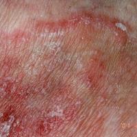 
	Tinea

	A leading scaly edge