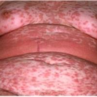 
	Adverse cutaneous drug reaction evolving into…