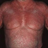 
	Erythrodermic psoriasis 