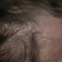 
	As previous image - hair loss