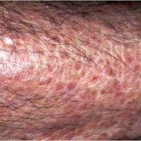 
	Papuloerythroderma of Ofuji

	Initial…