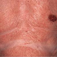 
	Papuloerythroderma of Ofuji

	Later on the rash…
