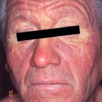 
	The S&eacute;zary syndrome

	Very infiltrated…