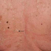 
	Erythroderma secondary to pityriasis rubra…
