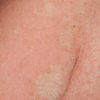 
	Erythroderma secondary to pityriasis rubra…