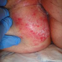 Extra-mammary Paget disease
Copied with kind…