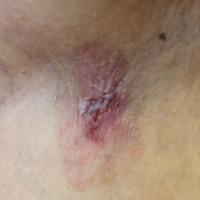 Extramammary Paget disease of the&nbsp;right…