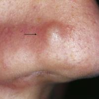 
	Fibrous papule