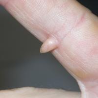 
	Acquired (digital) fibrokeratoma