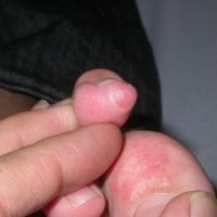 
	Acquired fibrous nodule