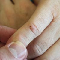 
	Acquired fibrous nodule