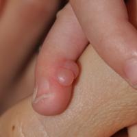 
	Infantile digital fibromatosis

	Copied with…