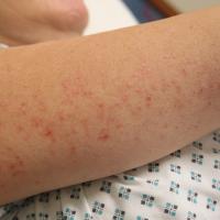 
	Flegel disease