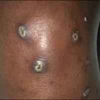 
	Acquired perforating dermatosis

	Central…
