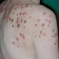 
	Acquired perforating dermatosis

	More…