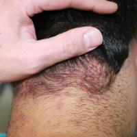 
	Acne keloidalis nuchae