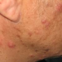
	Eosinophilic folliculitis in an HIV +ve patient