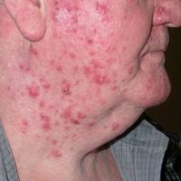 
	Tinea barbae