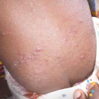 Folliculitis 
Copied with kind permission from…