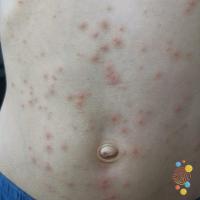 Folliculitis&nbsp;
Copied with kind permission…